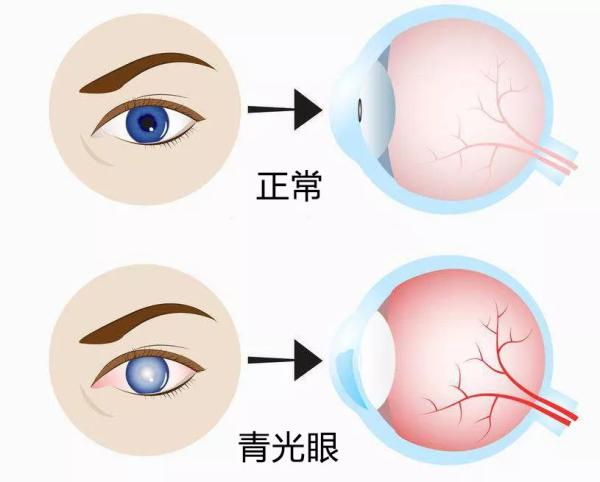 怎样预防青光眼？如何自己测试是否有患青光眼？